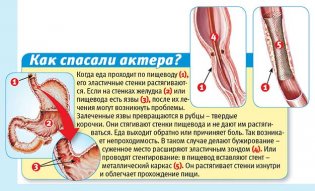 Дуров намучился после лечения язвы!