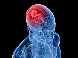 Опухоли мозга и методы его лечения